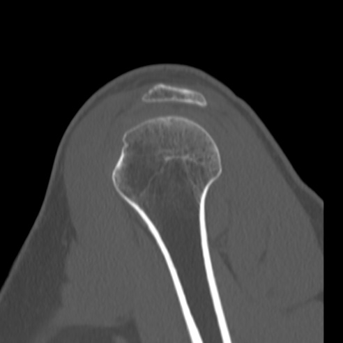 Bankart lesion (Radiopaedia 57256-64185 Sagittal bone window 16).jpg