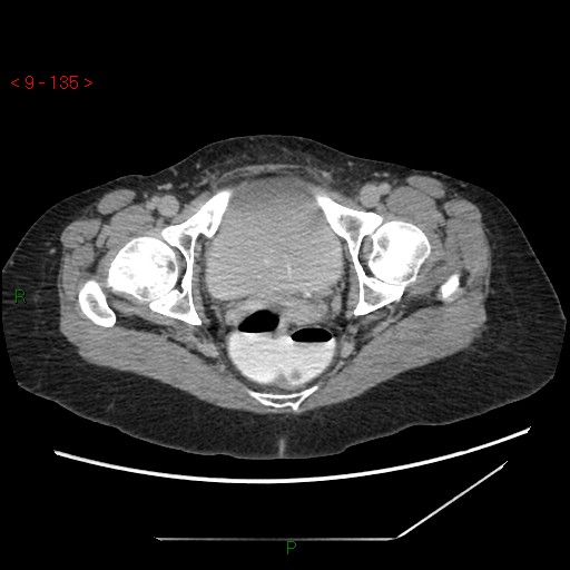 File:Bartholin gland cyst (Radiopaedia 54904-61181 Axial C+ delayed 34).jpg