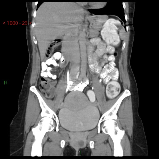 File:Bartholin gland cyst (Radiopaedia 54904-61181 Coronal C+ delayed 23).jpg