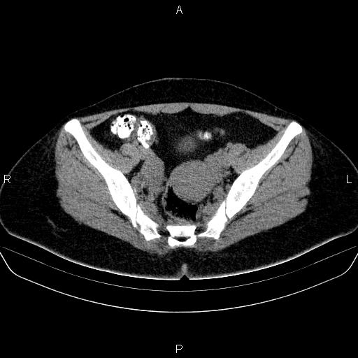 Bartholin gland cyst (Radiopaedia 62635-70930 Axial non-contrast 37).jpg