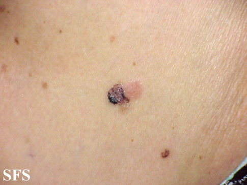 Basal Cell Carcinoma (Dermatology Atlas 77).jpg