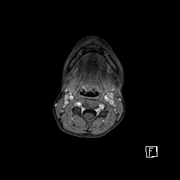 Base of skull rhabdomyosarcoma (Radiopaedia 32196-33142 T1 C+ fat sat 4).jpg
