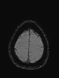 File:Basilar artery perforator aneurysm (Radiopaedia 82455-97733 Axial SWI 55).jpg