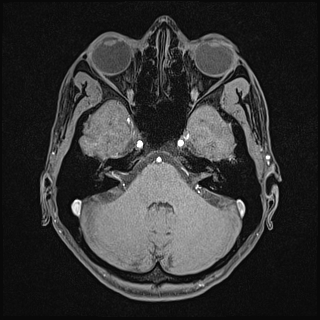 Basilar artery perforator aneurysm (Radiopaedia 82455-97733 Axial T1 fat sat 38).jpg