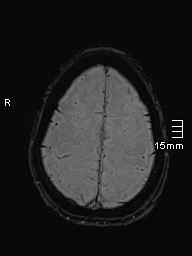 Basilar artery perforator aneurysm (Radiopaedia 82455-99523 Axial SWI 56).jpg