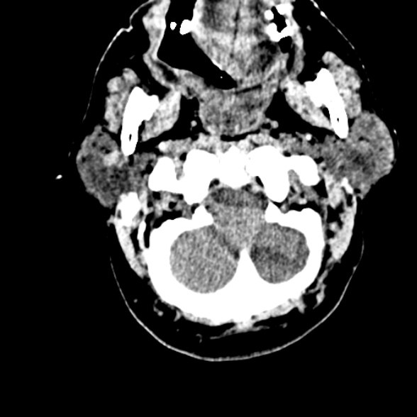 File:Basilar artery thrombosis (Radiopaedia 53351-59352 Axial non-contrast 16).jpg