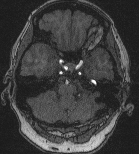 File:Basilar tip aneurysm (Radiopaedia 26504-26632 MRA 46).jpg
