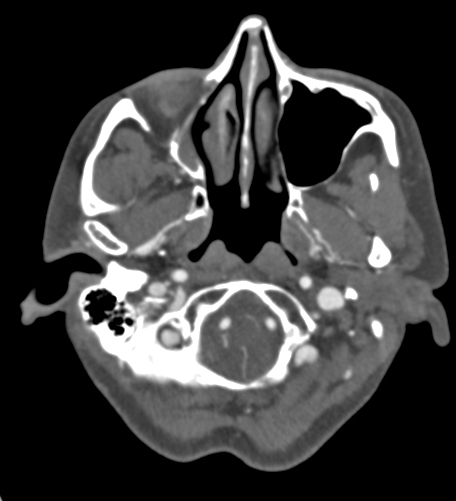 File:Basilar tip aneurysm with coiling (Radiopaedia 53912-60086 A 20).jpg