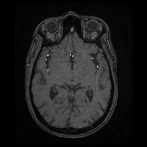 Basilar top and left middle cerebral artery aneurysm (Radiopaedia 61965-70031 Axial MRA 75).jpg