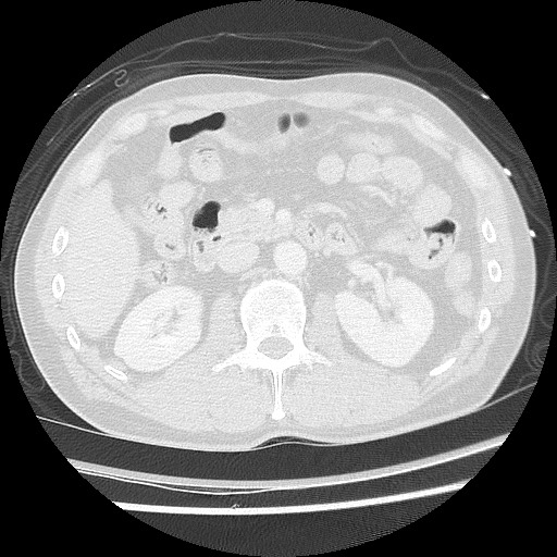 Benign post-traumatic pseudopneumoperitoneum (Radiopaedia 71199-81495 Axial lung window 81).jpg