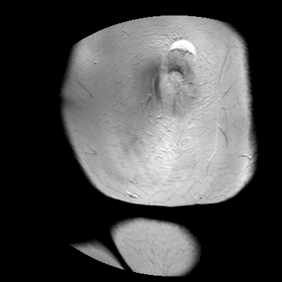 File:Benign seromucinous cystadenoma of the ovary (Radiopaedia 71065-81300 F 1).jpg