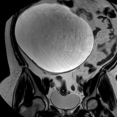 File:Benign seromucinous cystadenoma of the ovary (Radiopaedia 71065-81300 F 13).jpg