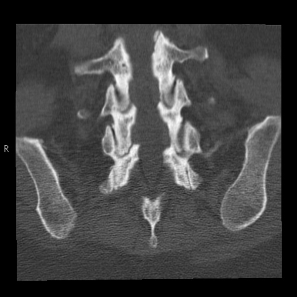 Bertolotti syndrome (Radiopaedia 24864-25128 Coronal bone window 36).jpg