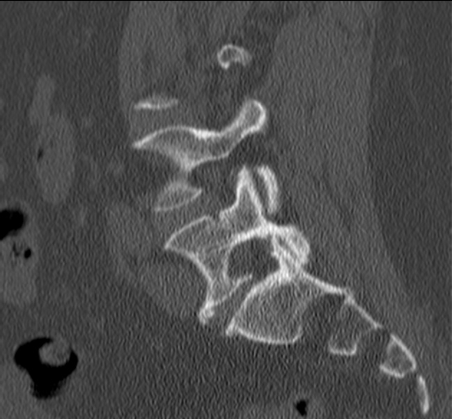 Bertolotti syndrome (Radiopaedia 24864-25128 Sagittal bone window 38).jpg