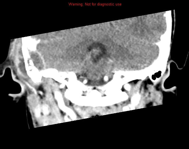 File:Bezold abscess (Radiopaedia 21645-21605 C+ arterial phase 16).jpg
