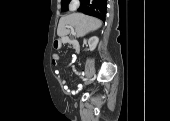 File:Bicameral celiacomesenteric aneurysm (Radiopaedia 55766-62327 B 22).jpg