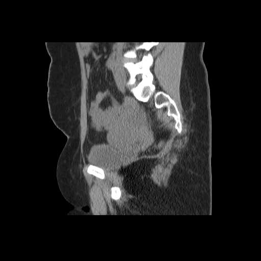 File:Bicornuate uterus- on MRI (Radiopaedia 49206-54296 A 7).jpg