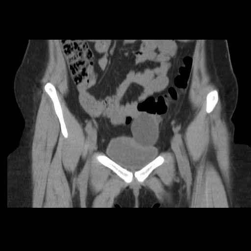 File:Bicornuate uterus- on MRI (Radiopaedia 49206-54296 Coronal non-contrast 4).jpg