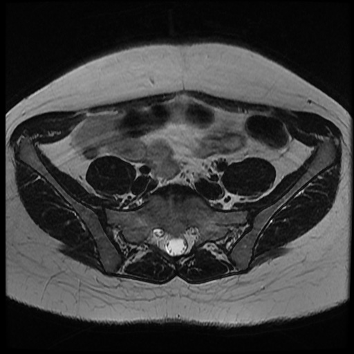 File:Bicornuate uterus (Radiopaedia 51676-57472 Axial T2 29).jpg