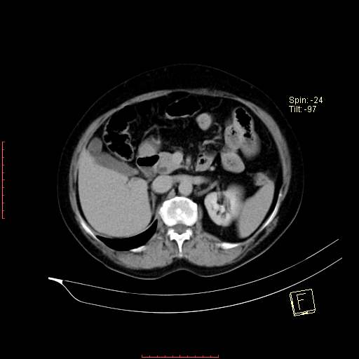 File:Bifid ureter (Radiopaedia 47604-52253 Axial C+ delayed 6).jpg