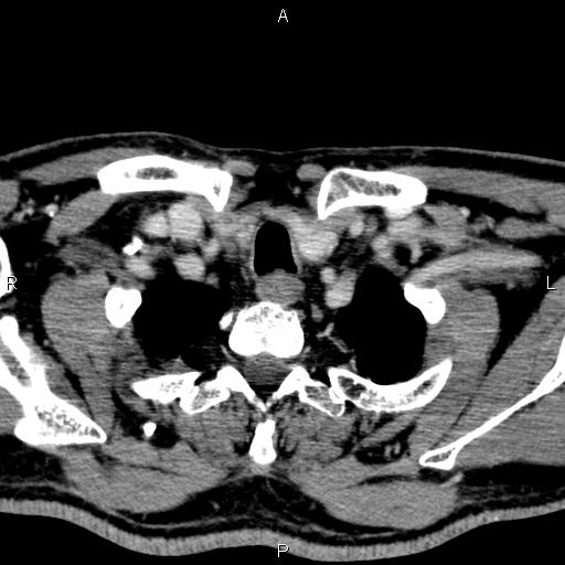 File:Bilateral Warthin tumors (Radiopaedia 84034-99263 Axial With contrast 62).jpg