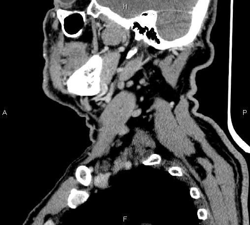 Bilateral Warthin tumors (Radiopaedia 84034-99263 D 56).jpg