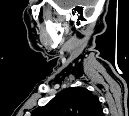 Bilateral Warthin tumors (Radiopaedia 84034-99263 D 59).jpg