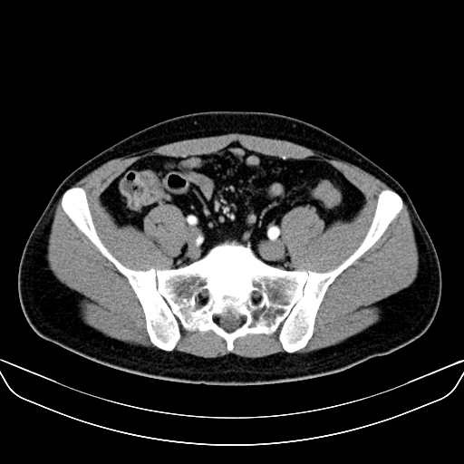 Bilateral accessory renal arteries with mild pelvi-ureteric junction (PUJ) obstruction (Radiopaedia 66357-75596 A 52).jpg