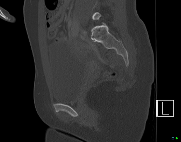File:Bilateral acetabular fractures (Radiopaedia 79272-92308 Sagittal bone window 38).jpg