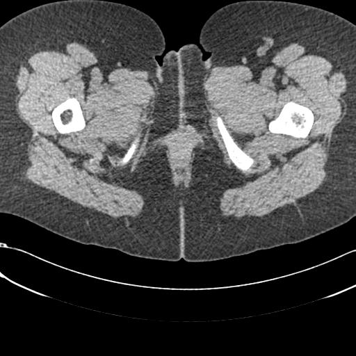 Bilateral acetabular protrusion with pincer type femoro-acetabular impingement (Radiopaedia 30134-30733 AXIAL SOFT THIN 113).jpg