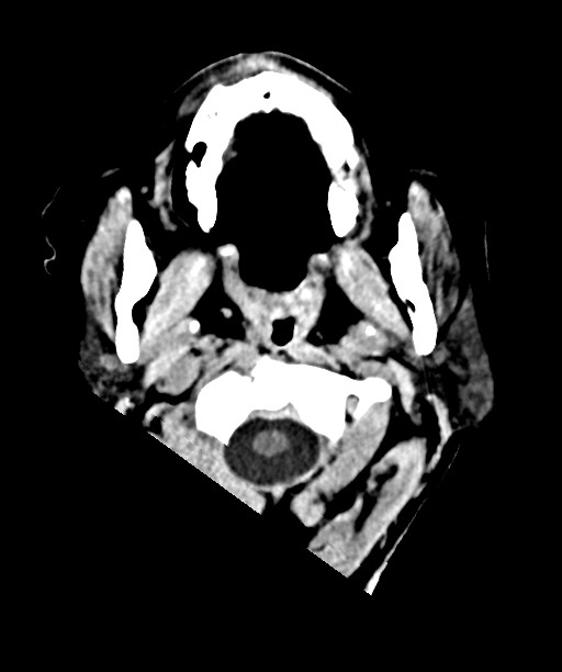 Bilateral acute on chronic subdural hematomas (Radiopaedia 78466-91146 Axial non-contrast 4).jpg