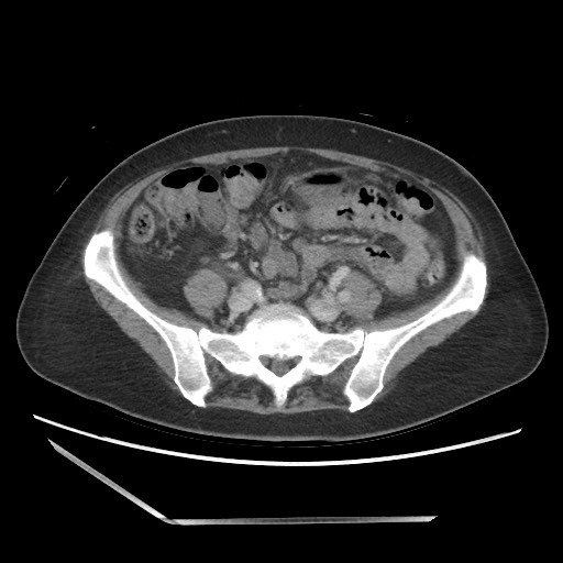 File:Bilateral adrenal granulocytic sarcomas (chloromas) (Radiopaedia 78375-91007 Axial 22).jpg