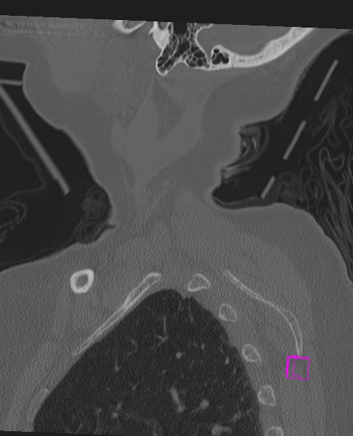 Bilateral atlanto-occipital assimilation (Radiopaedia 28350-28603 Sagittal bone window 5).jpg