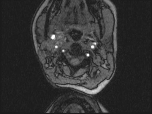 Bilateral carotid body tumors and right glomus jugulare tumor (Radiopaedia 20024-20060 Axial MRA 269).jpg