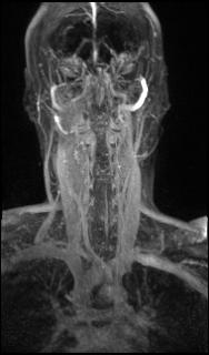 Bilateral carotid body tumors and right glomus jugulare tumor (Radiopaedia 20024-20060 MRA 145).jpg