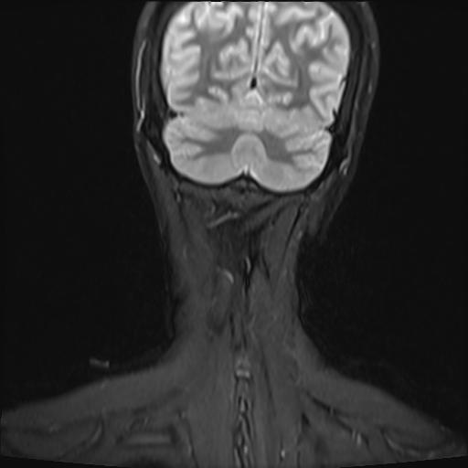 File:Bilateral carotid body tumors and right jugular paraganglioma (Radiopaedia 20024-20060 Coronal 47).jpg