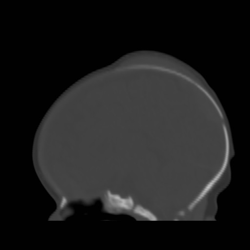 File:Bilateral cephalohematomas and subdural hematomas (Radiopaedia 26778-26929 Sagittal bone window 20).jpg