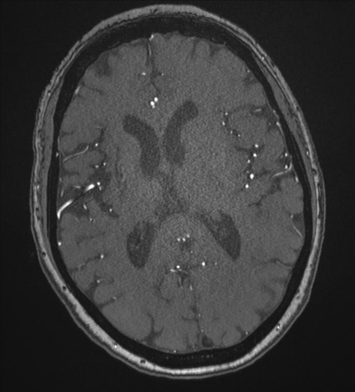 Bilateral fetal posterior communicating arteries (Radiopaedia 41286-44102 Axial MRA 124).png