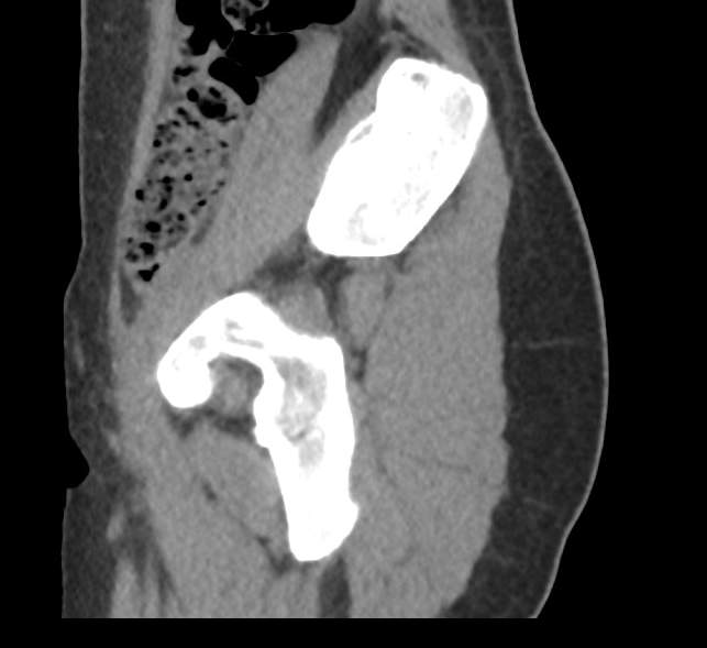 File:Bilateral mature cystic ovarian teratoma (Radiopaedia 88821-105592 D 1).jpg