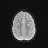 File:Bilateral mesial temporal polymicrogyria (Radiopaedia 76456-88181 Axial DWI 20).jpg
