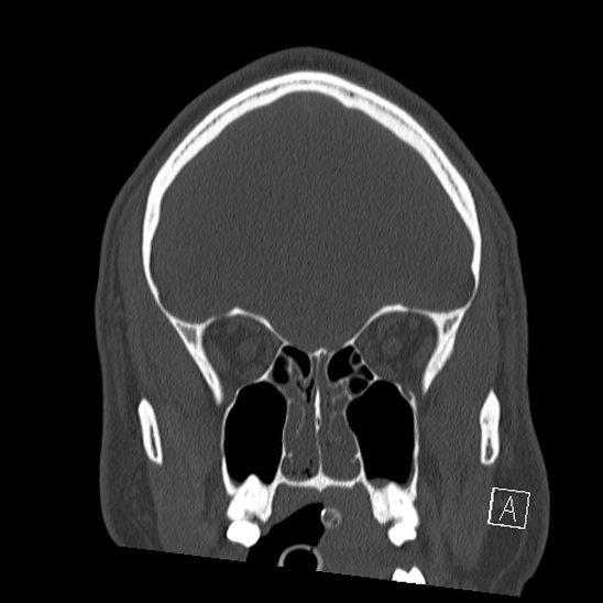 Bilateral occipital condyle fracture (type 2) (Radiopaedia 87675-104089 Coronal bone window 23).jpg