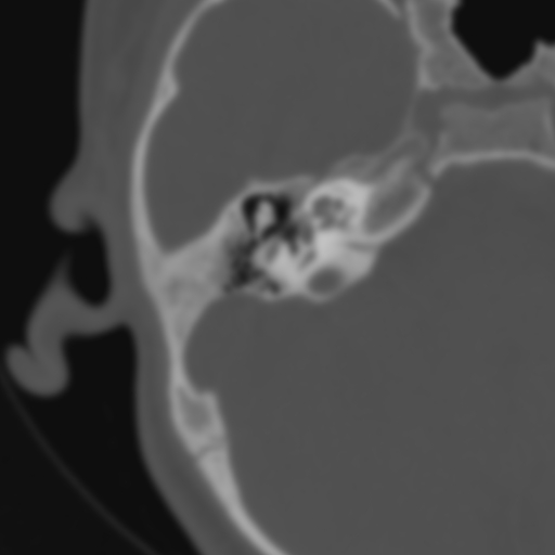 Bilateral otosclerosis (Radiopaedia 57237-64157 B 58).jpg