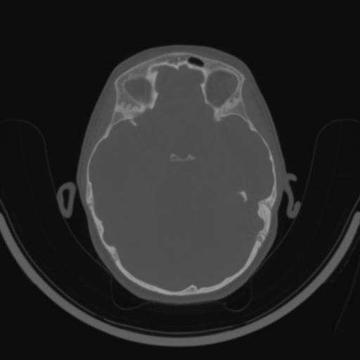 Bilateral otosclerosis (Radiopaedia 57237-64157 C 73).jpg