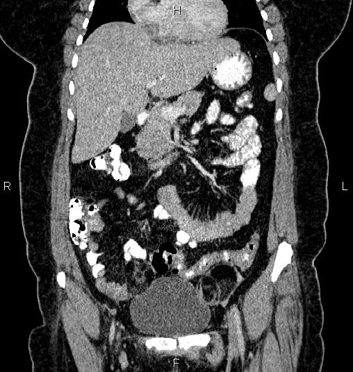 Bilateral ovarian dermoid cysts (Radiopaedia 85785-101603 C 17).jpg