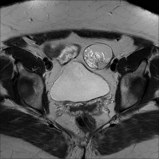 File:Bilateral ovarian dermoid cysts (Radiopaedia 90152-107338 Axial T2 14).jpg