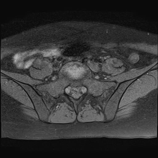 File:Bilateral ovarian endometriomas (Radiopaedia 87085-103347 Axial T1 fat sat 1).jpg
