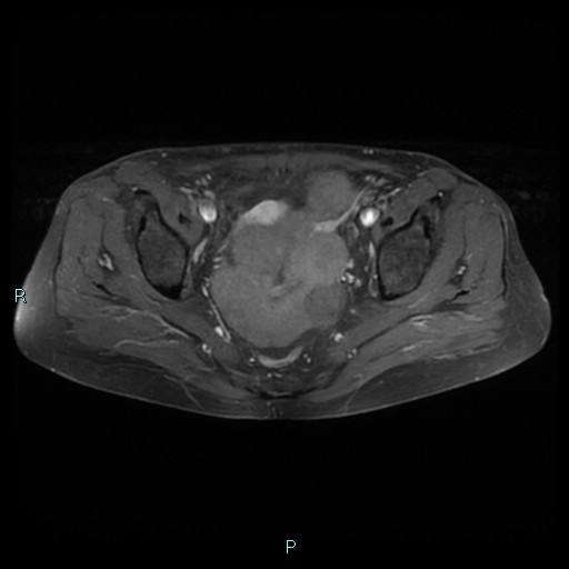 File:Bilateral ovarian fibroma (Radiopaedia 44568-48293 Axial T1 C+ fat sat 16).jpg