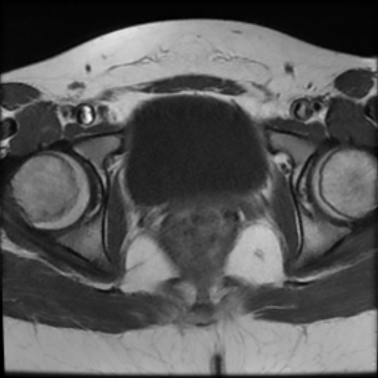 File:Bilateral ovarian fibrothecomas - adolescent (Radiopaedia 86604-102707 Axial T1 24).jpg
