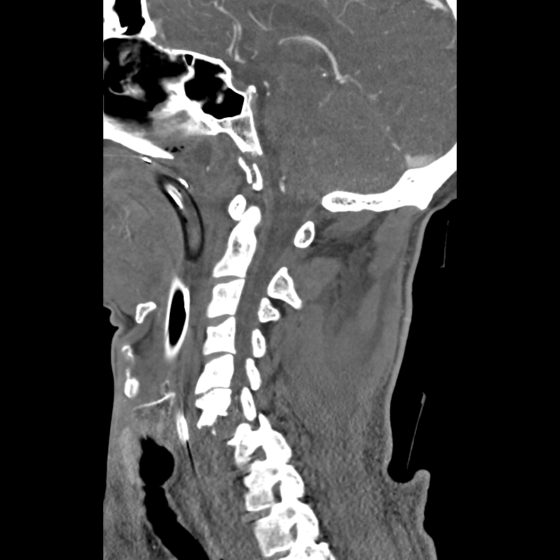 Bilateral perched facets with cord injury (Radiopaedia 45587-49713 B 21).jpg