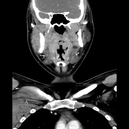 File:Bilateral peritonsillar abscess (Radiopaedia 85065-100610 Coronal 31).jpg